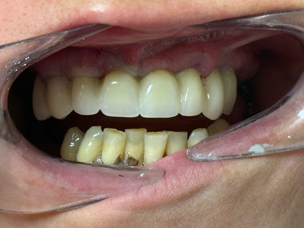 antes_implantes_rapidos_24_en_villareal_clinica_se_tu